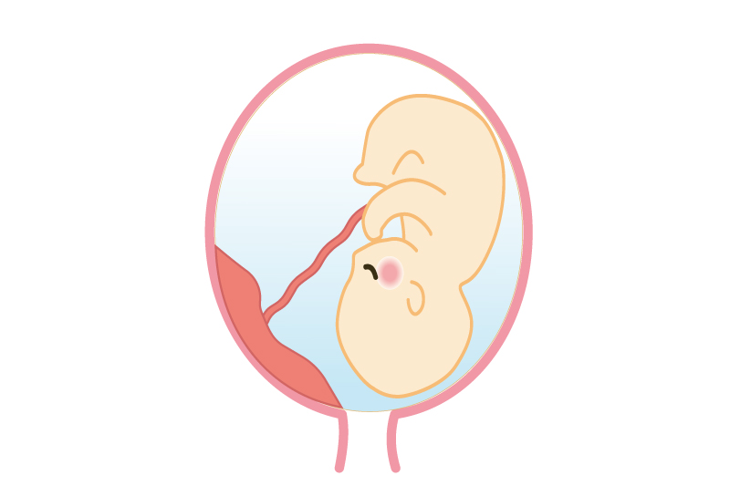 低置胎盤のイメージ図