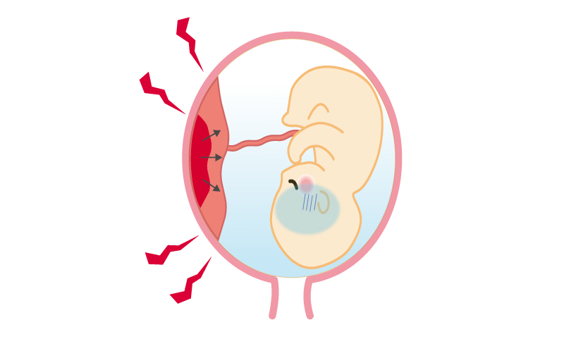 常位胎盤早期剝離のイメージ図