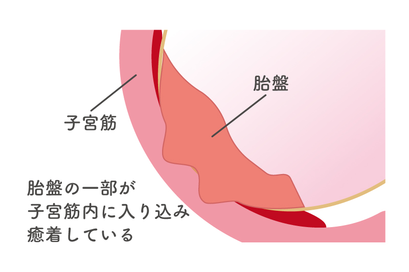 癒着胎盤のイメージ図