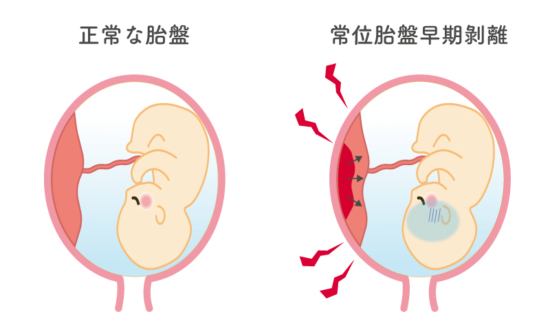 常位胎盤早期剝離のイメージ図