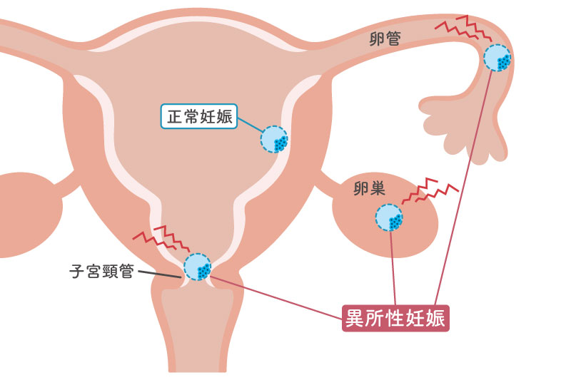 異所性妊娠