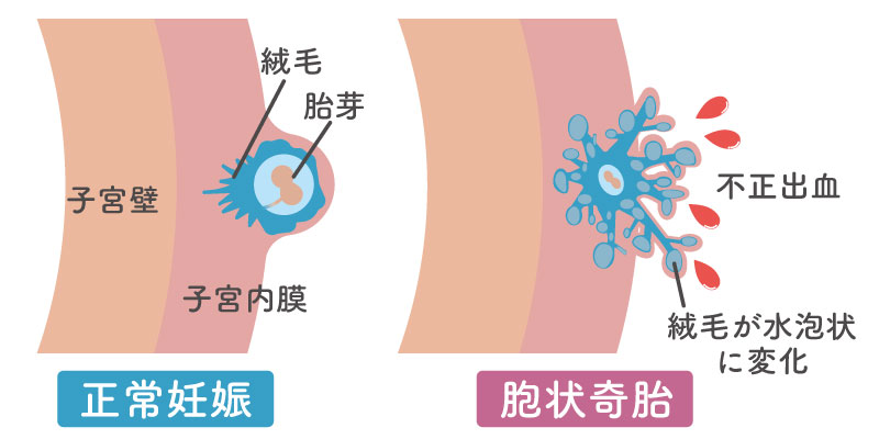 正常妊娠と胞状奇胎の違い